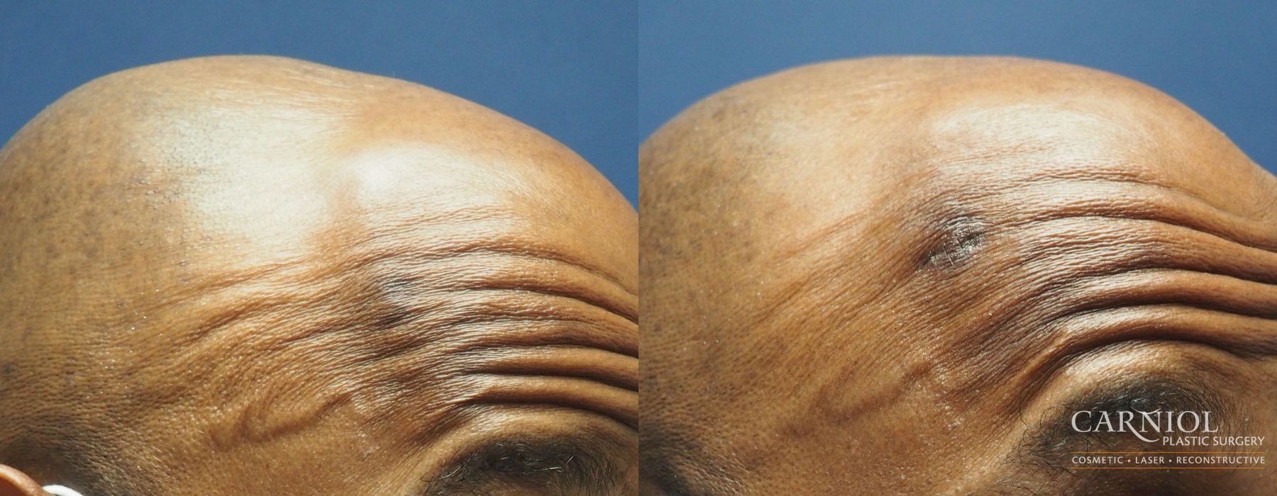 Mole or Age Spot Removal - Thumbnail 2