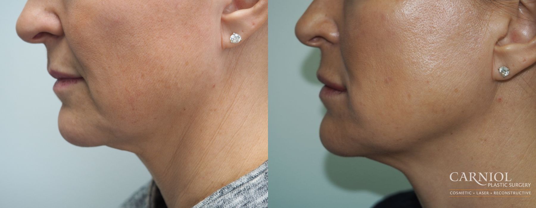 Non-Surgical Facelift - Case 2818