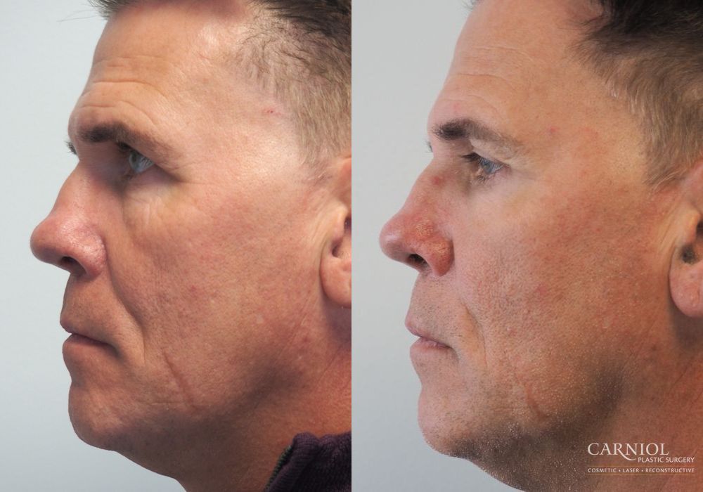 Non-Surgical Facelift - Thumbnail 3