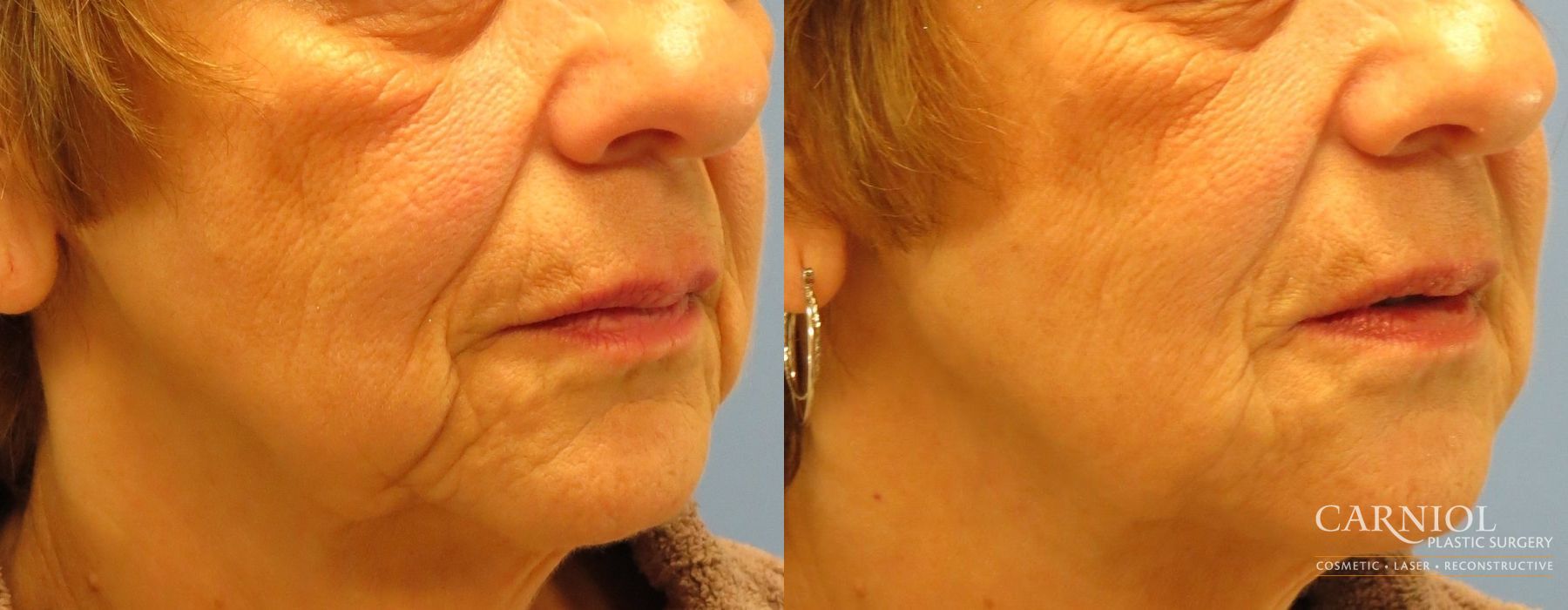 Non-Surgical Facelift - Thumbnail 2