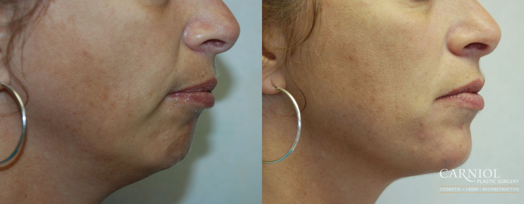 Non-Surgical Facelift - Case 2812