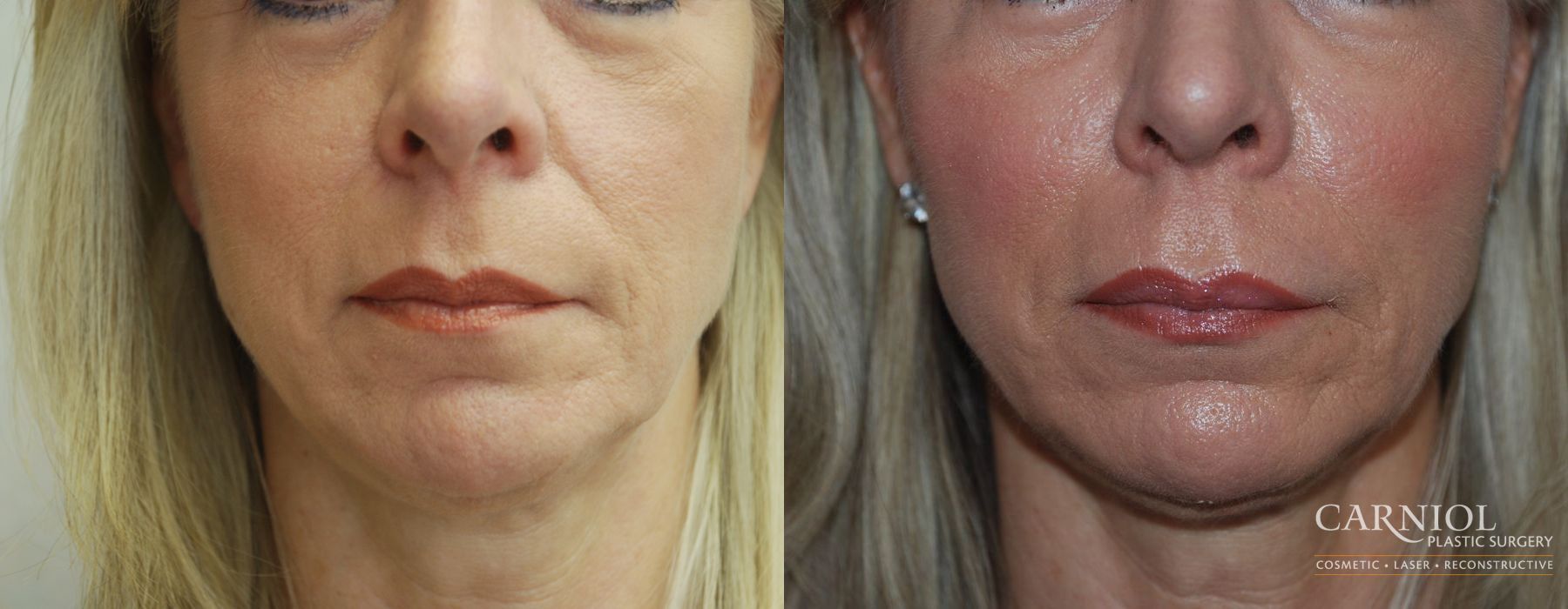Non-Surgical Facelift - Case 2815