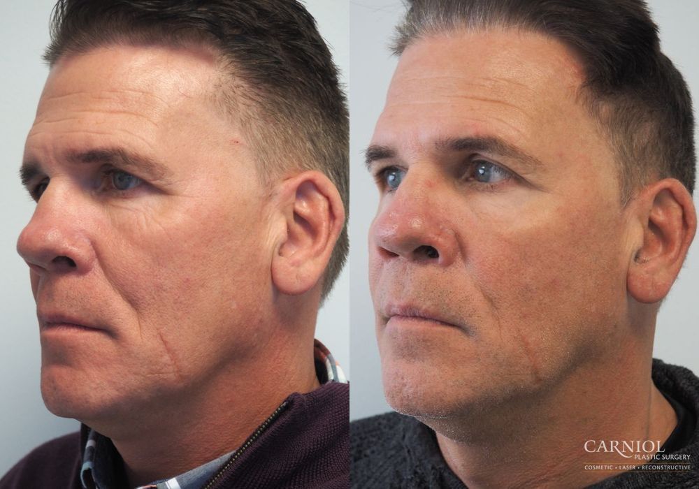 Non-Surgical Facelift - Case 2821