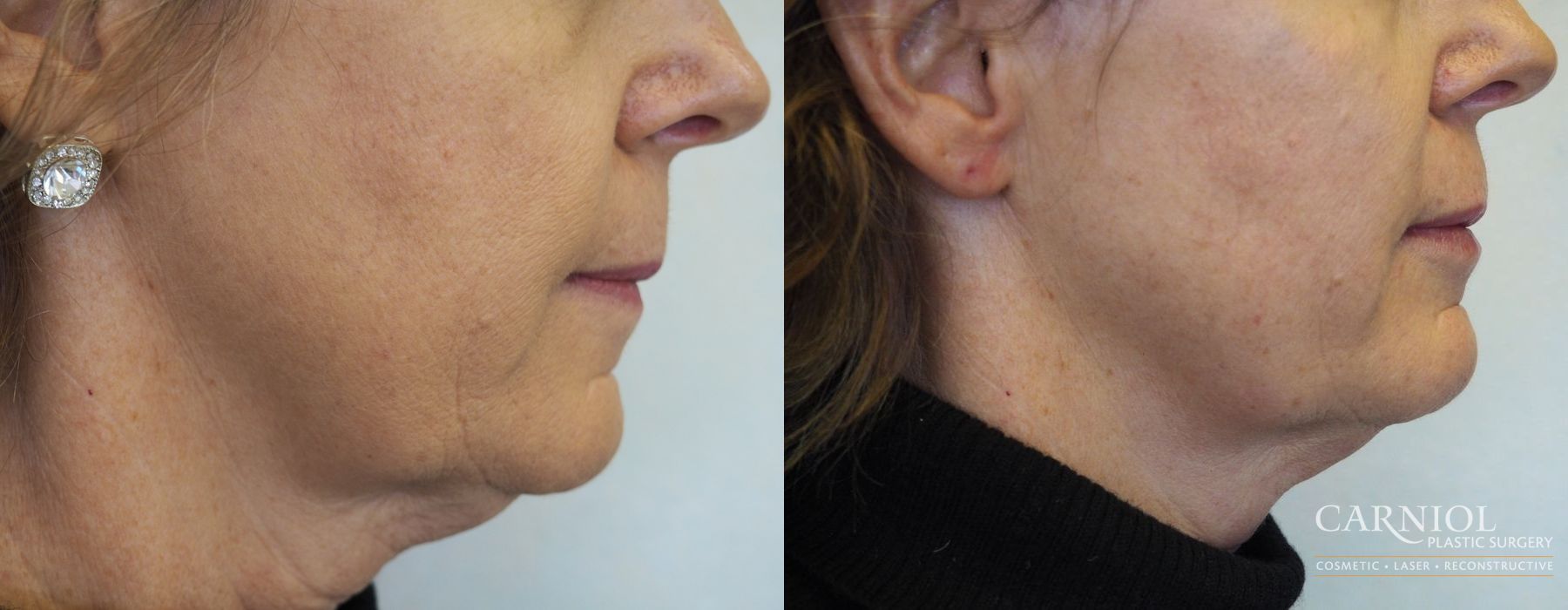 Non-Surgical Mini-Facelift - Case 2826