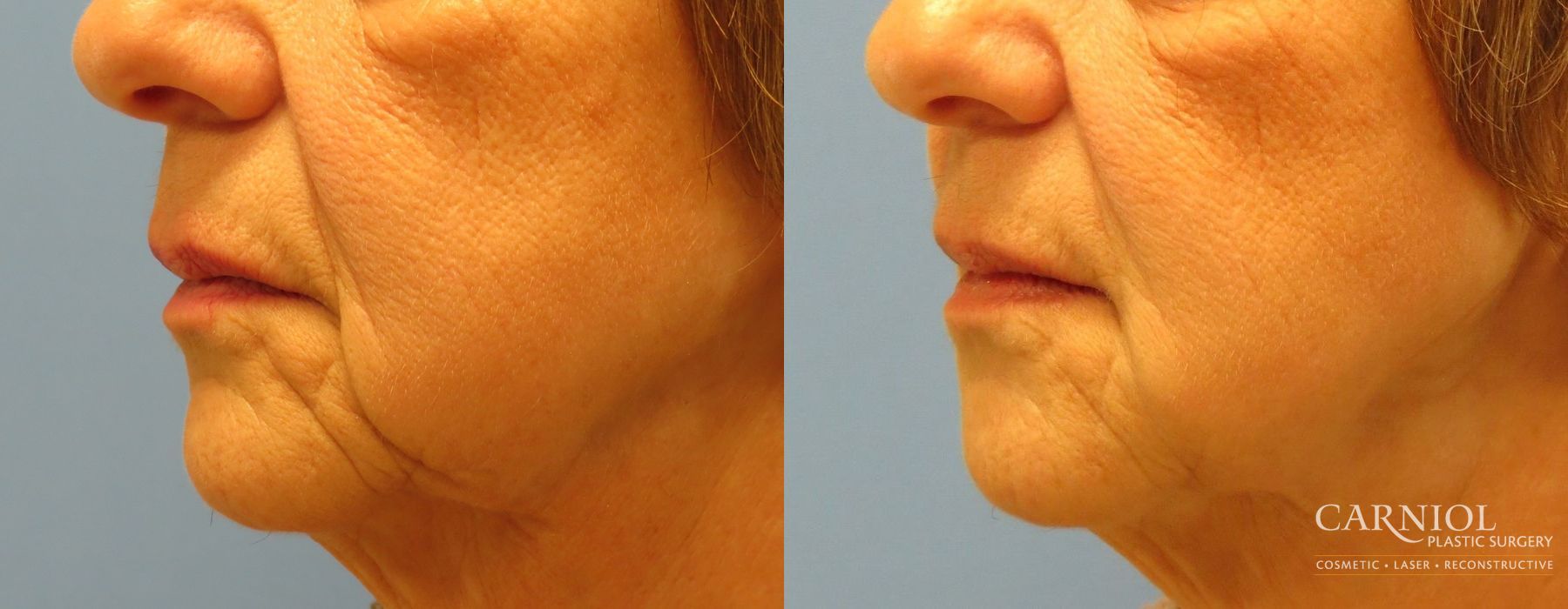 Non-Surgical Mini-Facelift - Thumbnail 3