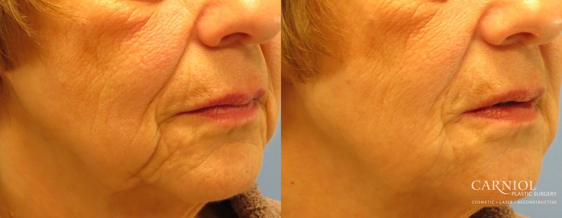 Non-Surgical Mini-Facelift - Thumbnail 2