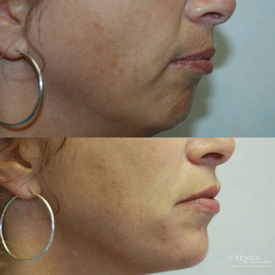 Non-Surgical Mini-Facelift - Case 2824
