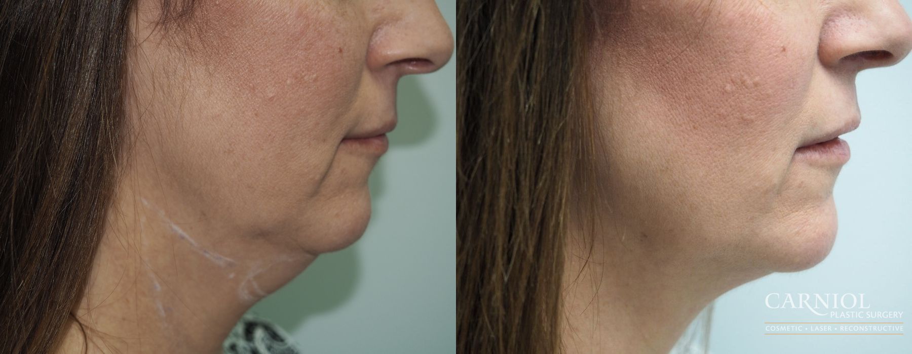 Non-Surgical Neck Lift - Case 2737