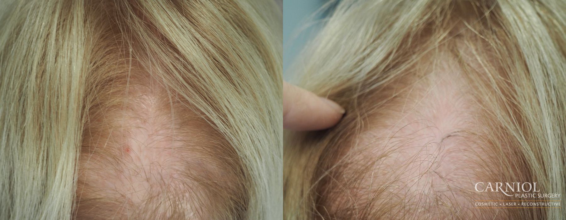 Nonsurgical Hair Restoration - Case 2833