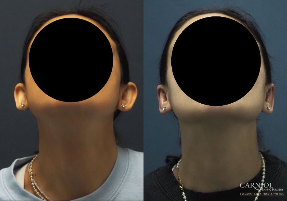 Otoplasty - Thumbnail 4