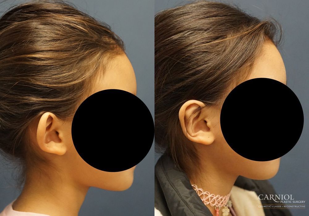 Otoplasty - Thumbnail 4