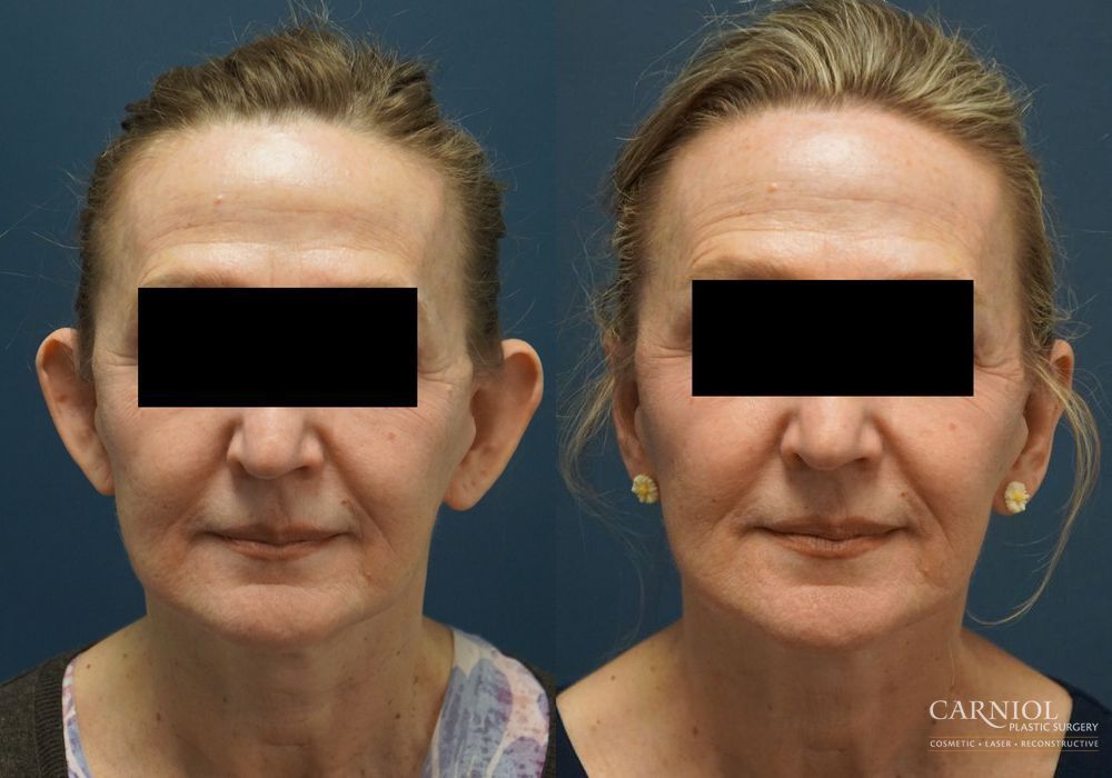 Otoplasty - Case 2740