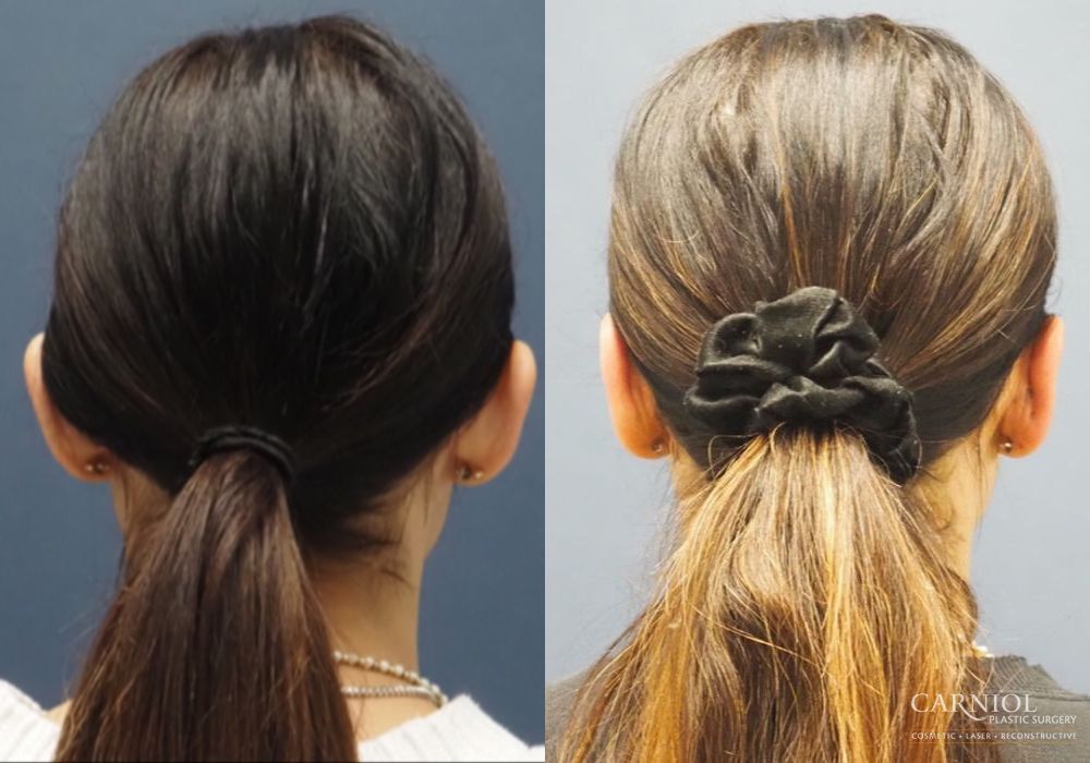 Otoplasty - Thumbnail 7