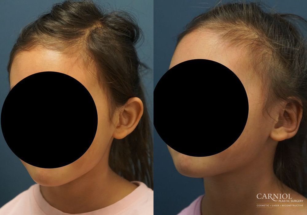 Otoplasty - Thumbnail 3