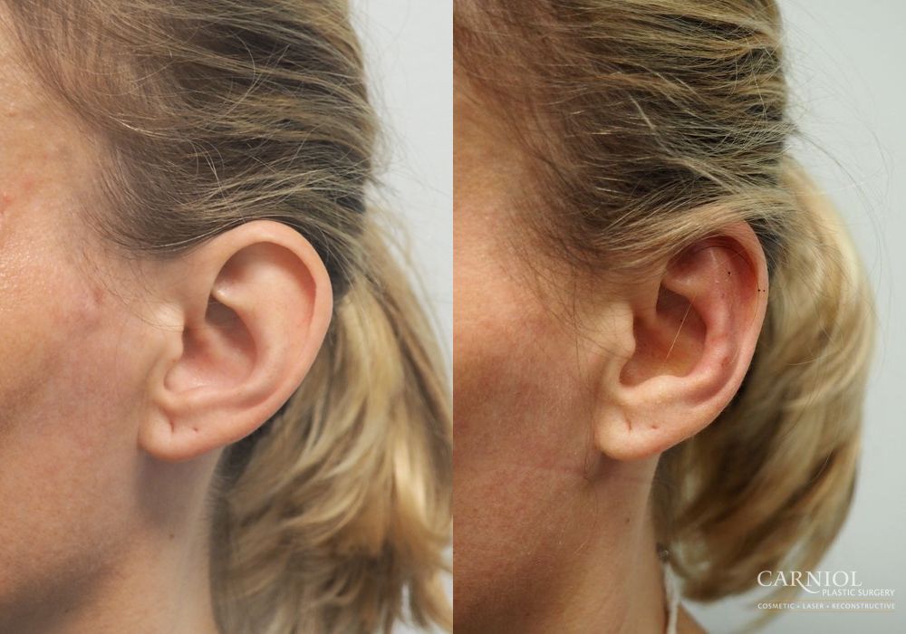 Otoplasty - Thumbnail 4