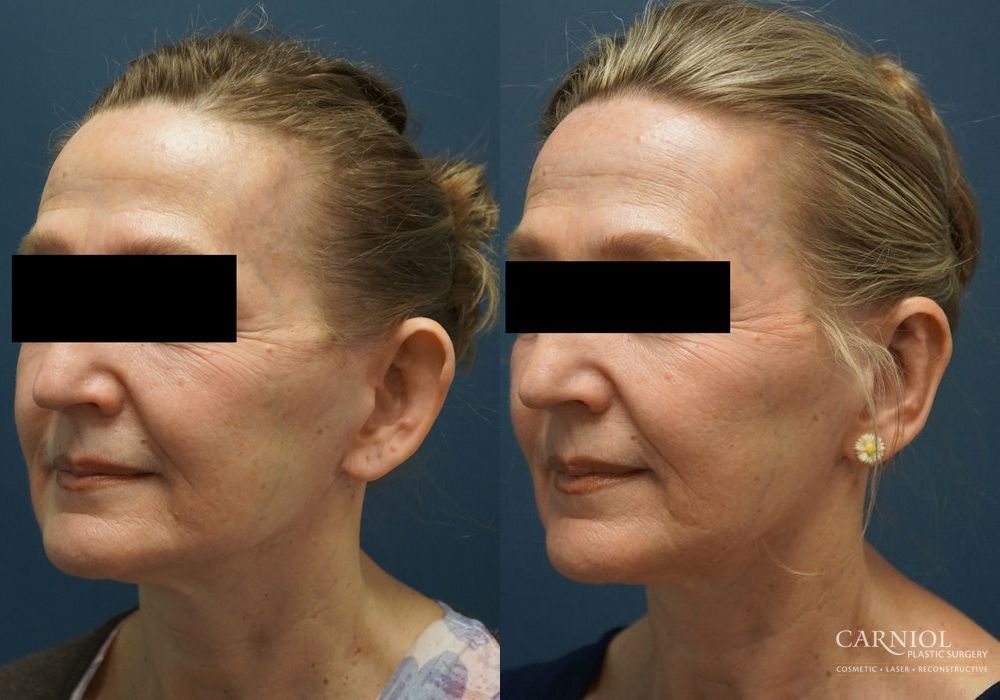 Otoplasty - Thumbnail 5