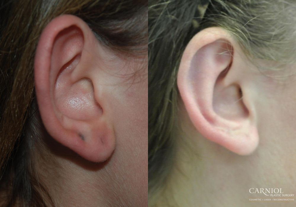 Otoplasty - Thumbnail 2