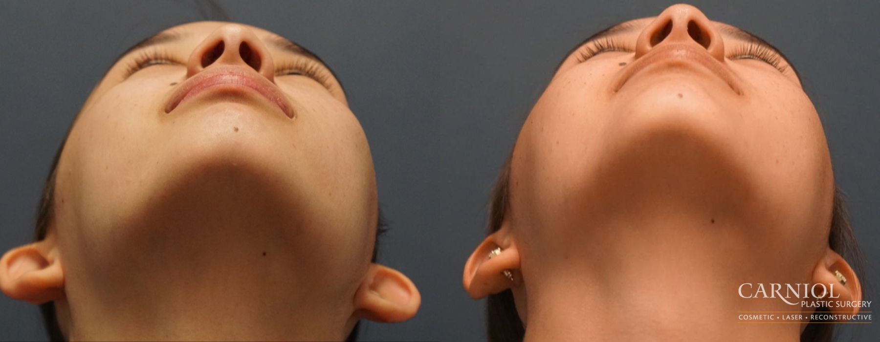 Otoplasty - Thumbnail 7