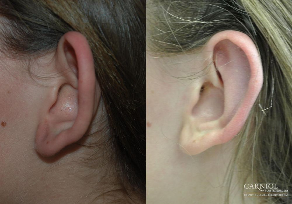 Otoplasty young woman