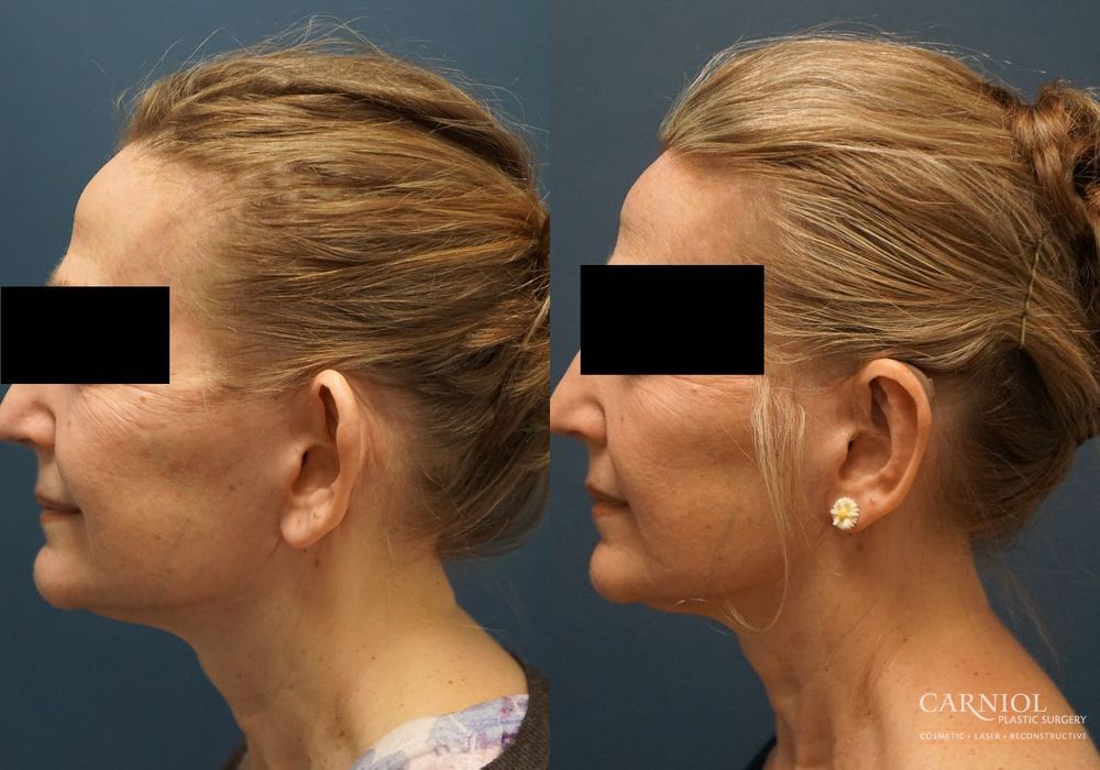 Otoplasty - Thumbnail 4