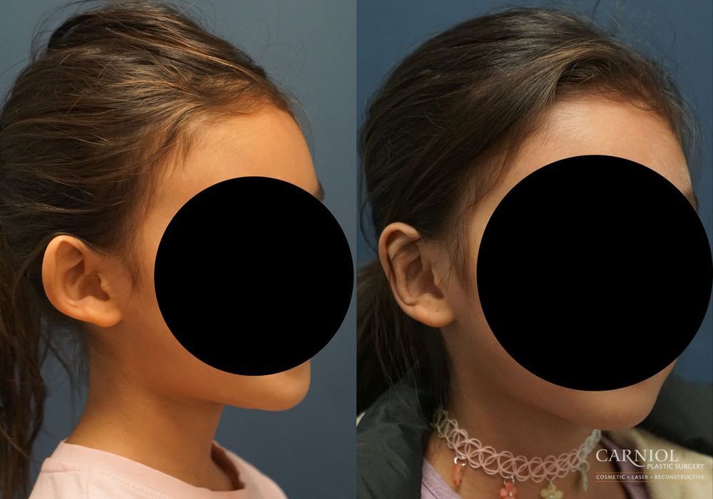 Otoplasty - Thumbnail 2