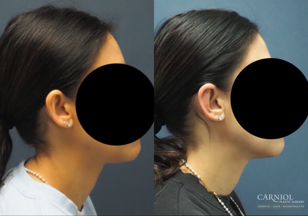 Otoplasty - Thumbnail 4