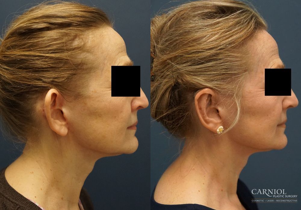 Otoplasty - Thumbnail 3