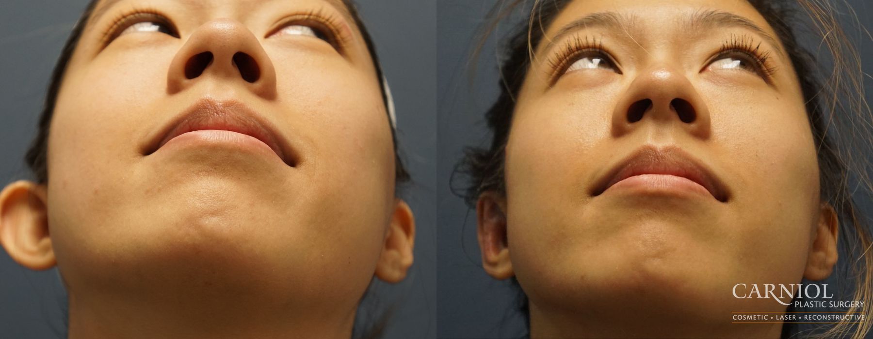 Otoplasty - Thumbnail 3