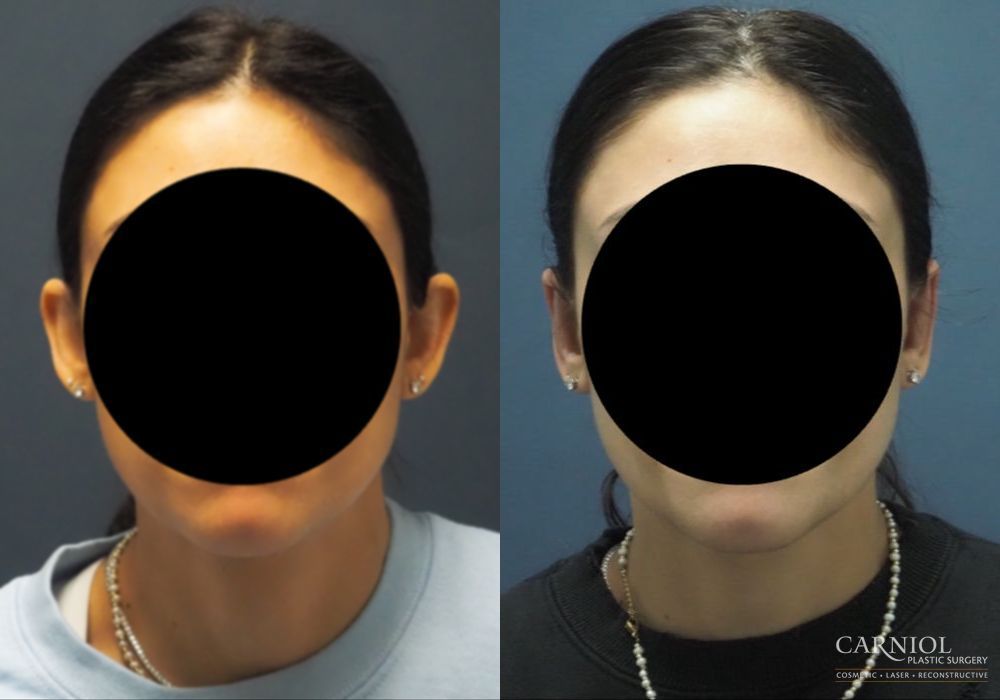 Otoplasty - Thumbnail 5