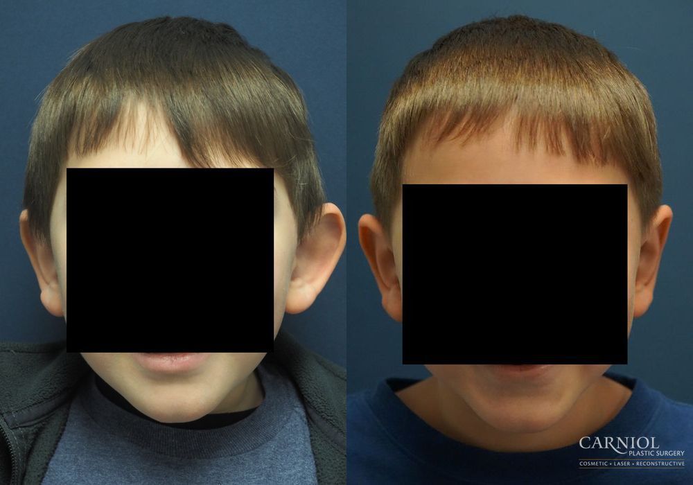 Otoplasty - Case 2749