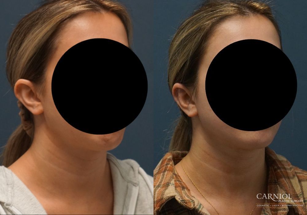 Otoplasty - Thumbnail 2