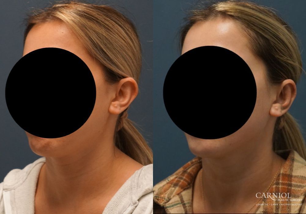 Otoplasty - Thumbnail 4