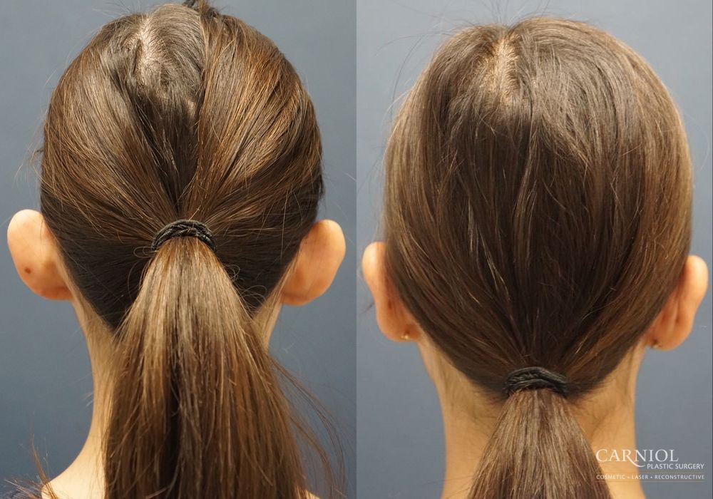 Otoplasty - Thumbnail 4