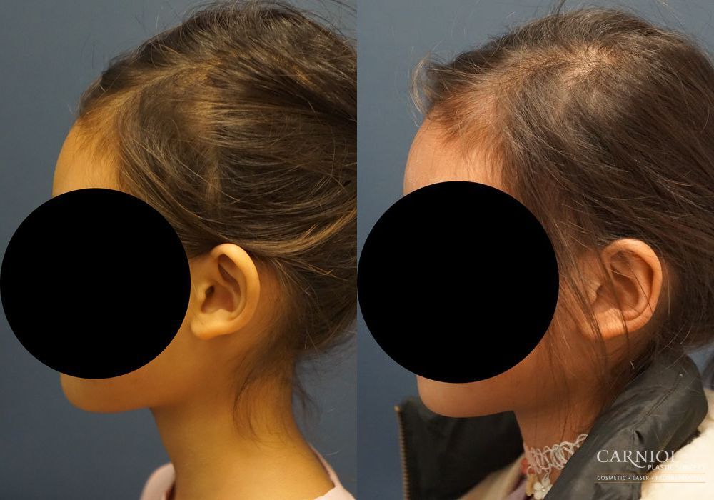 Otoplasty - Thumbnail 5