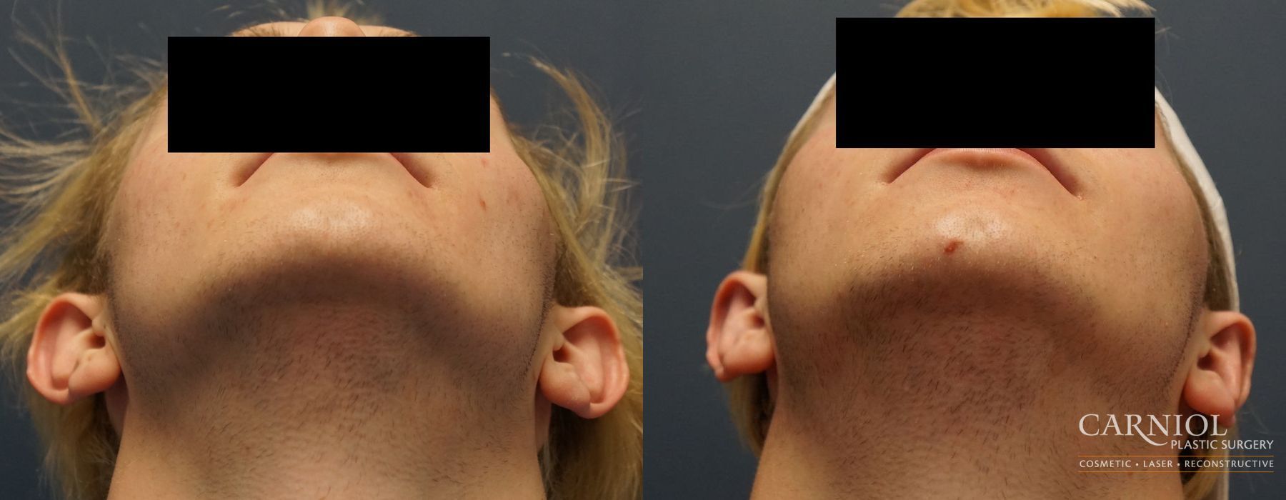 Otoplasty - Thumbnail 2