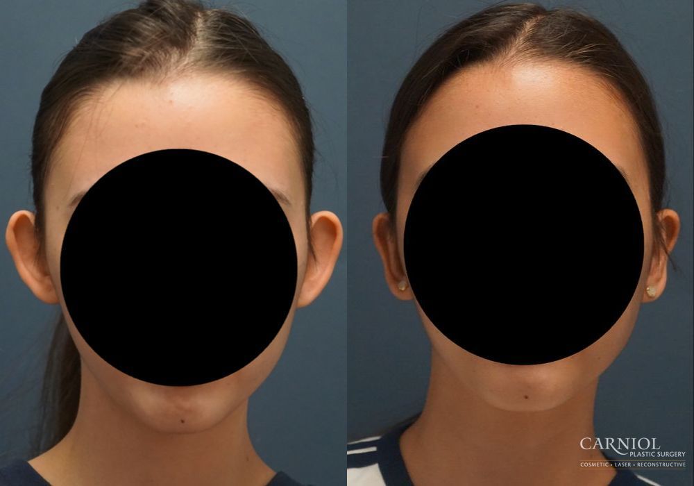 Otoplasty - Case 2742