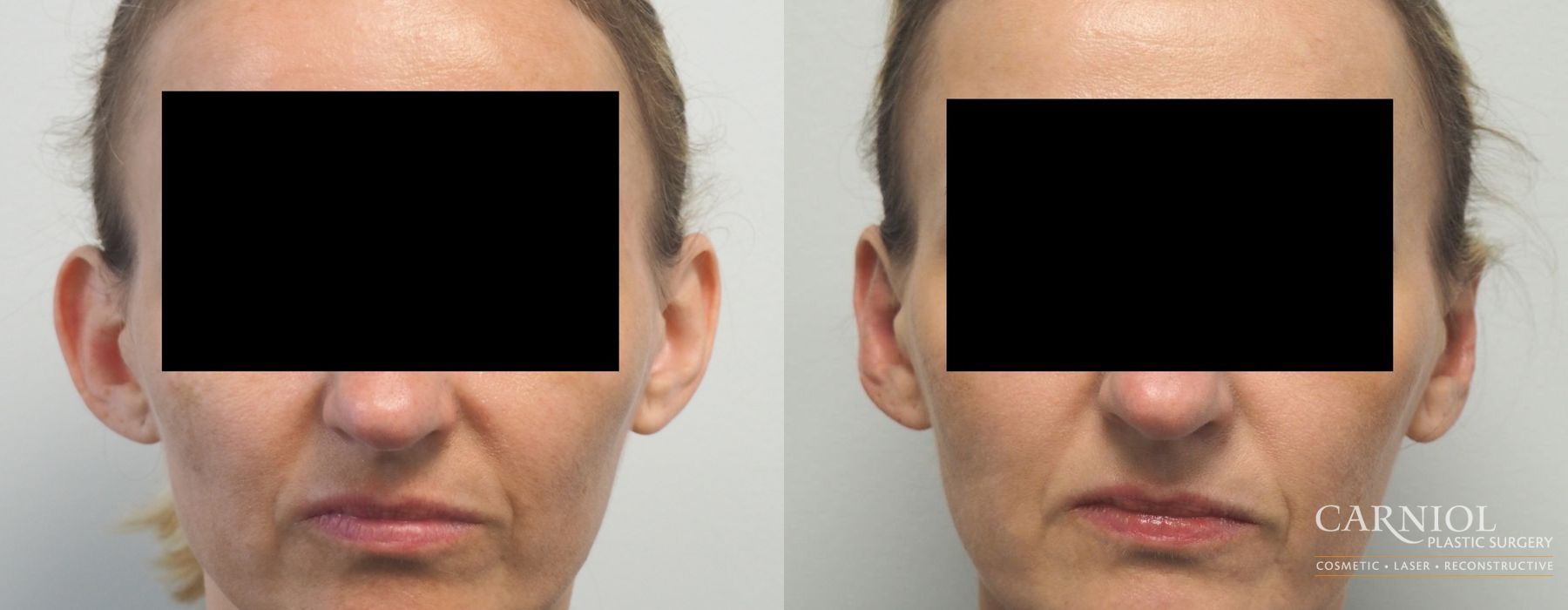 Otoplasty - Case 2743