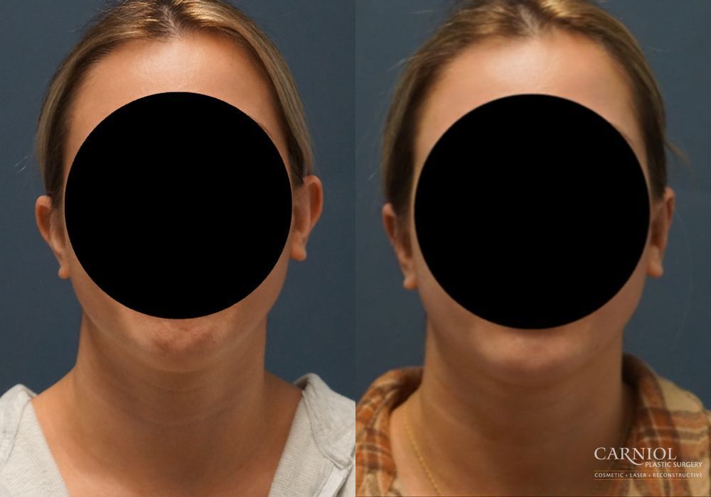 Otoplasty - Case 2750