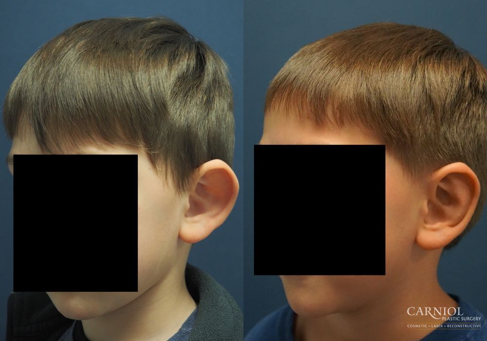 Otoplasty - Thumbnail 2