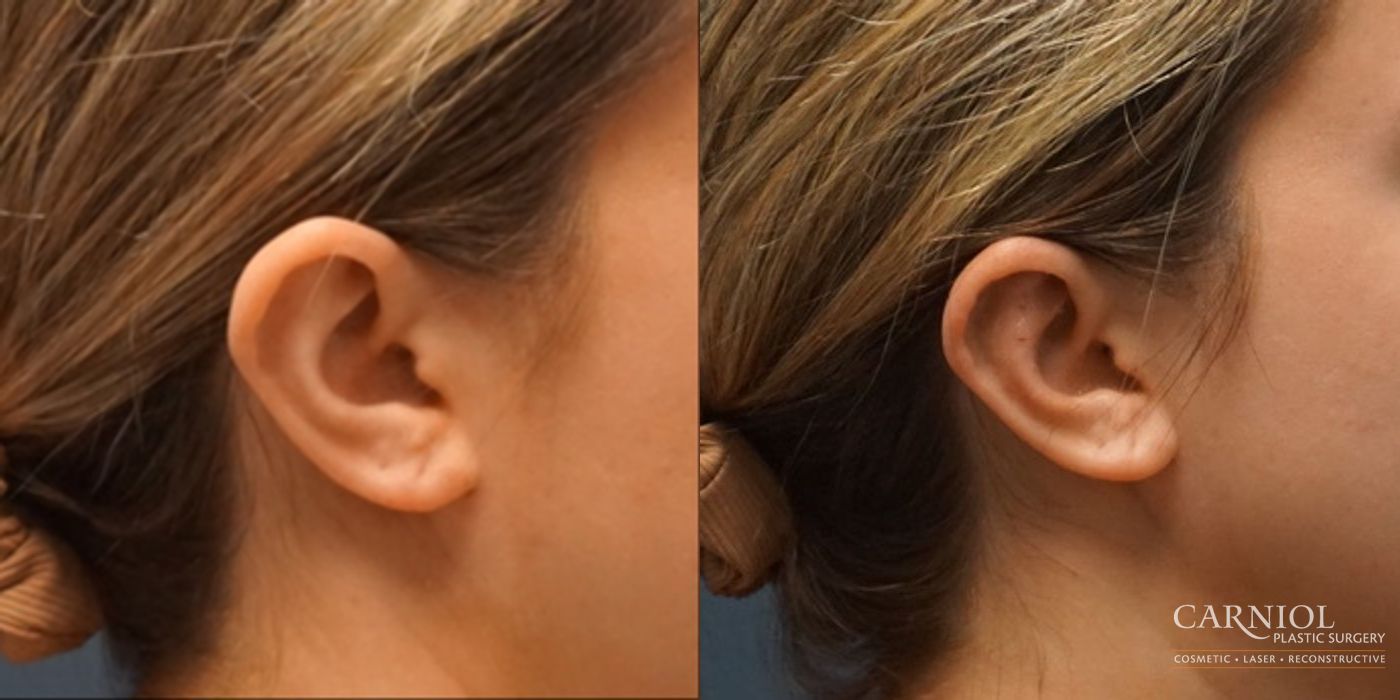 Otoplasty - Thumbnail 3