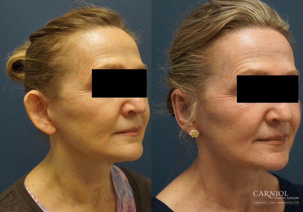 Otoplasty - Thumbnail 2