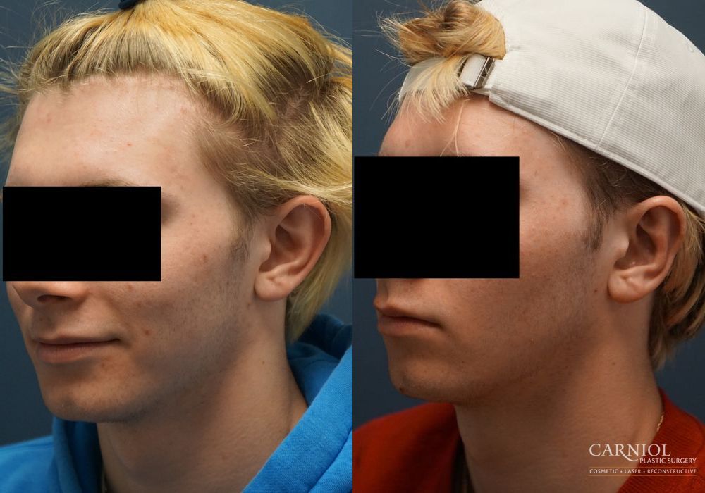 Otoplasty - Thumbnail 4