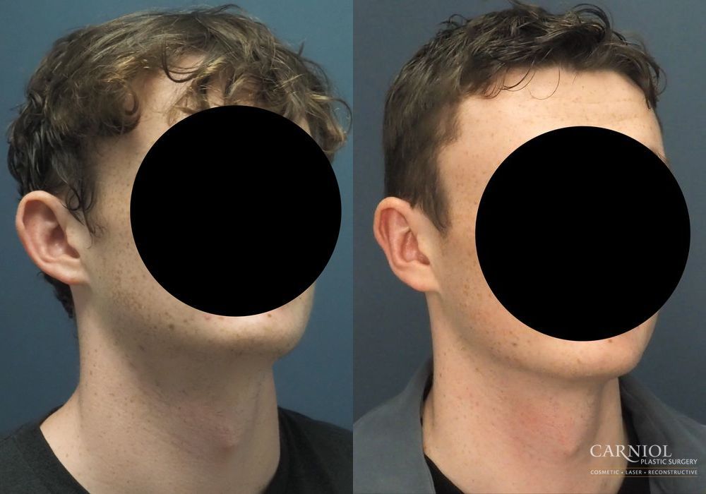 Otoplasty - Thumbnail 2