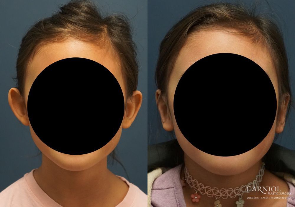 Otoplasty - Case 2745