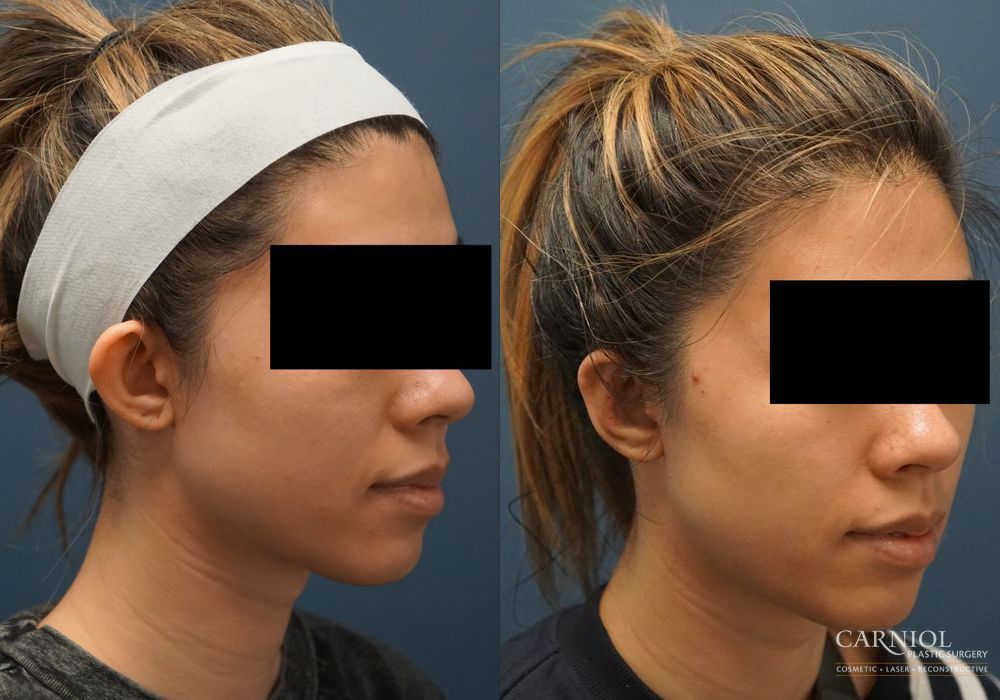 Otoplasty - Thumbnail 2