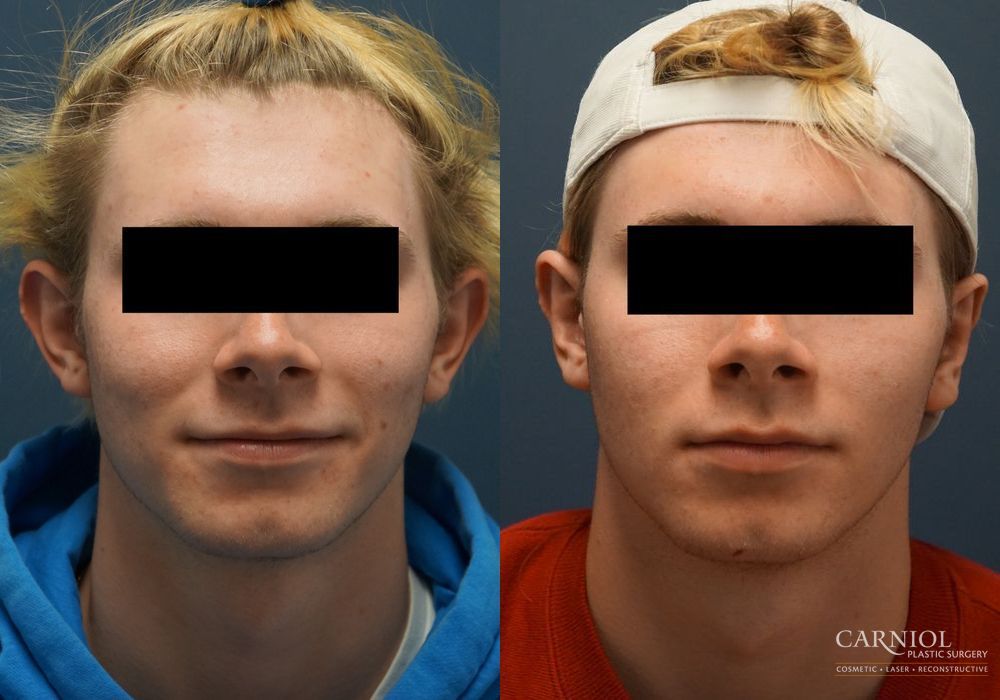 Otoplasty - Case 2747