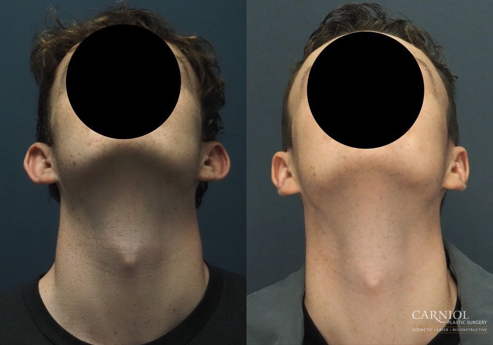 Otoplasty - Thumbnail 4