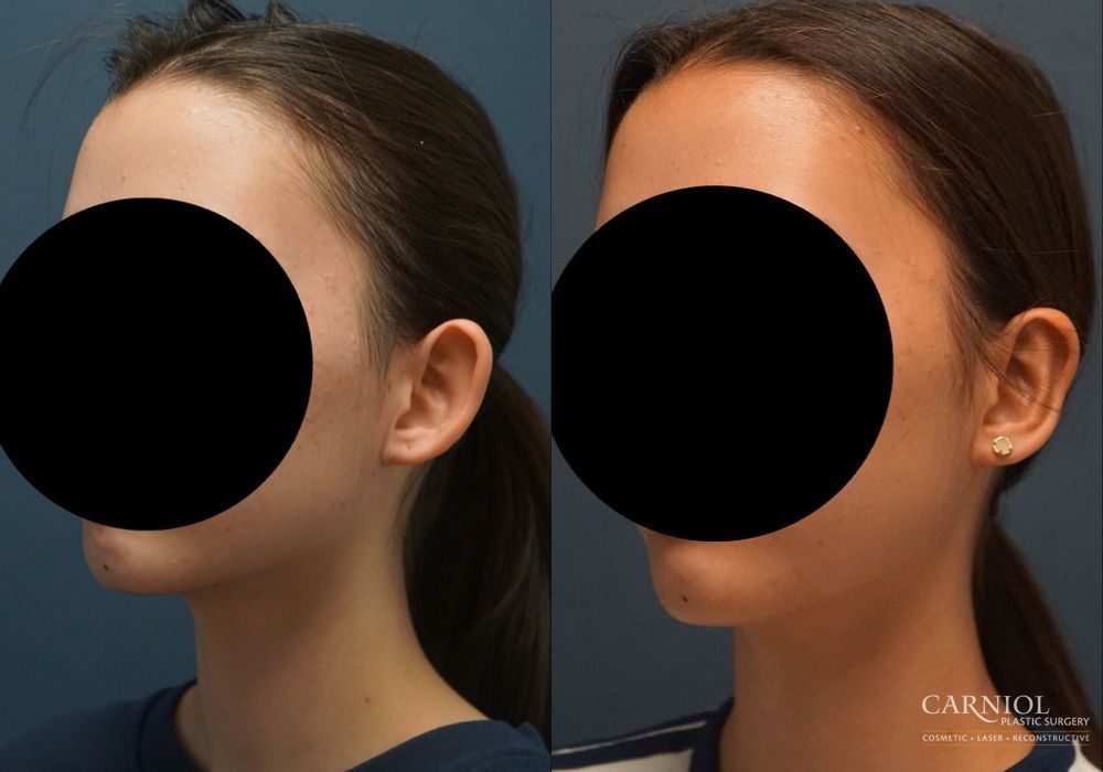 Otoplasty - Thumbnail 6