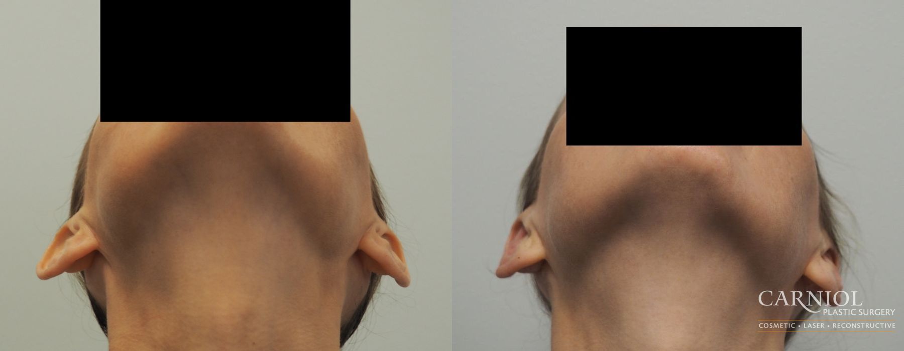 Otoplasty - Thumbnail 2