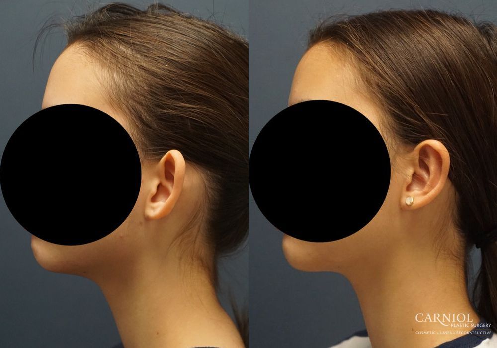 Otoplasty - Thumbnail 5